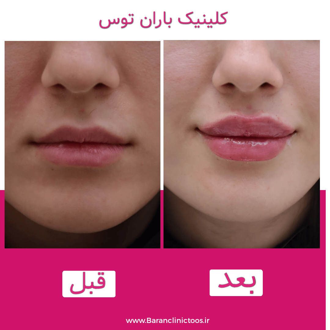 قبل و بعد فیلر لب